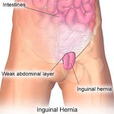 Obat Herbal Hernia